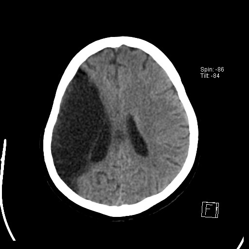 Brain Stroke SERIES 001 IMG 0016